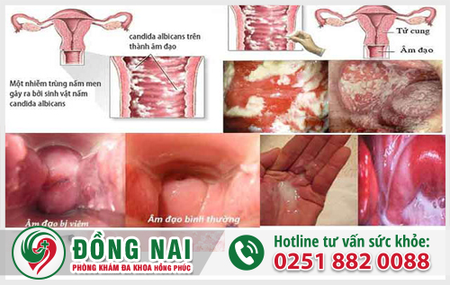 Hình ảnh bệnh viêm âm đạo