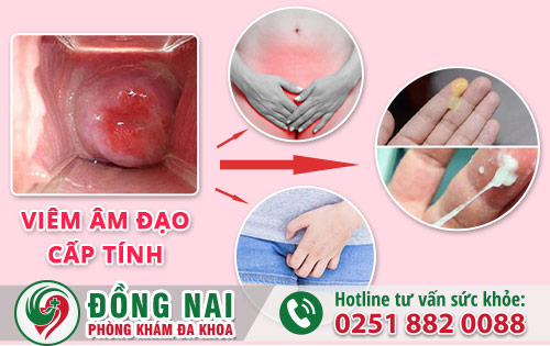 Triệu chứng giúp chị em nhận biết bệnh viêm âm đạo cấp tính