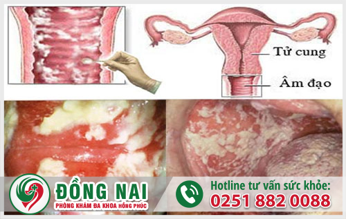 Dấu hiệu nhận biết bệnh viêm âm đạo chị em nên biết
