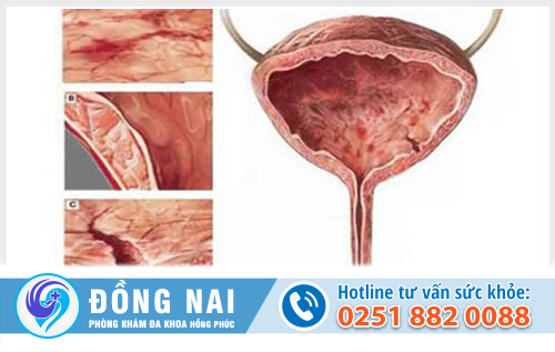 Viêm bàng quang kẽ là bệnh gì?