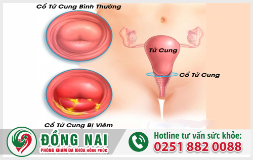 Viêm cổ tử cung là bệnh gì?