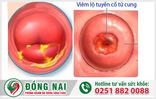 Nhiều chị em thắc mắc không biết chi phí điều trị viêm lộ tuyến cổ tử cung là bao nhiêu?