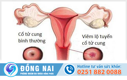 Viêm lộ tuyến cổ tử cung là bệnh gì?