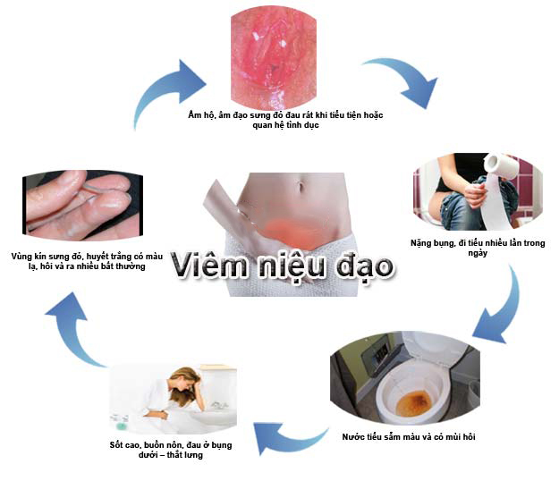 Dấu hiệu viêm niệu đạo ở nữ giới