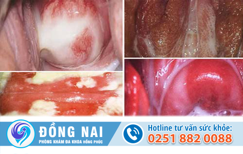 Vùng kín có mùi chua tanh là vì sao vậy