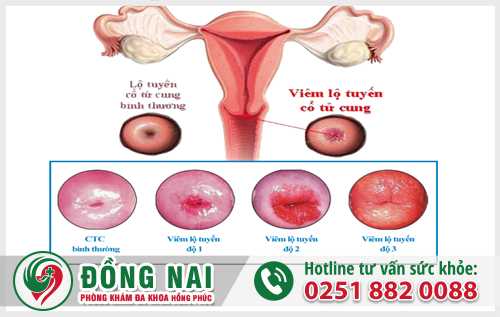 Viêm lộ tuyến cổ tử cung là một trong những nguyên nhân gây vùng kín ngứa và có mùi